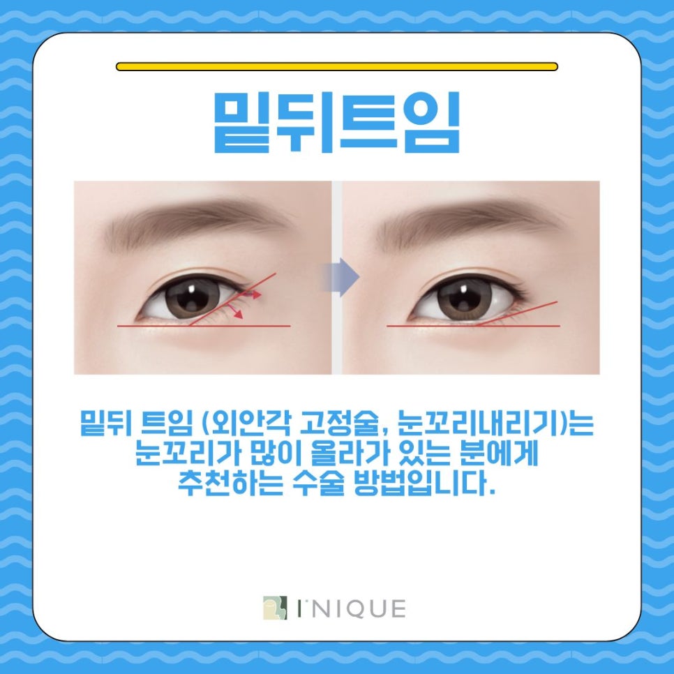 작은눈성형, 이게 답이다! 관련 이미지 7