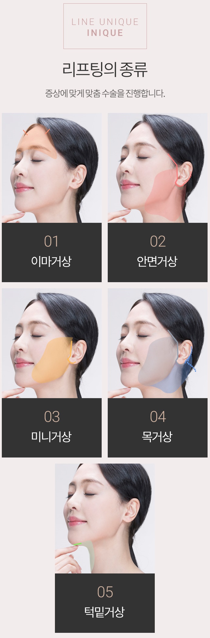최소절개리프팅 받고 젊어지자! 관련 이미지 2