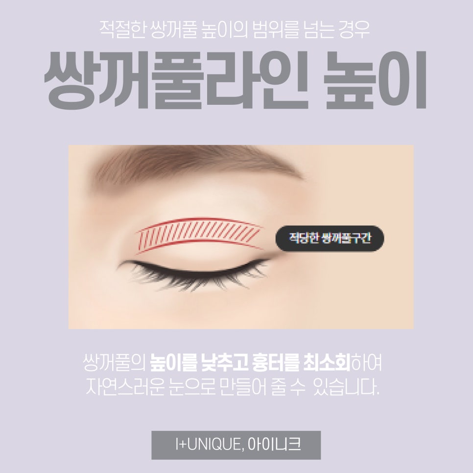 속상한 쌍꺼풀라인낮추기 아이니크성형외과에서 해결하자 관련 이미지 3
