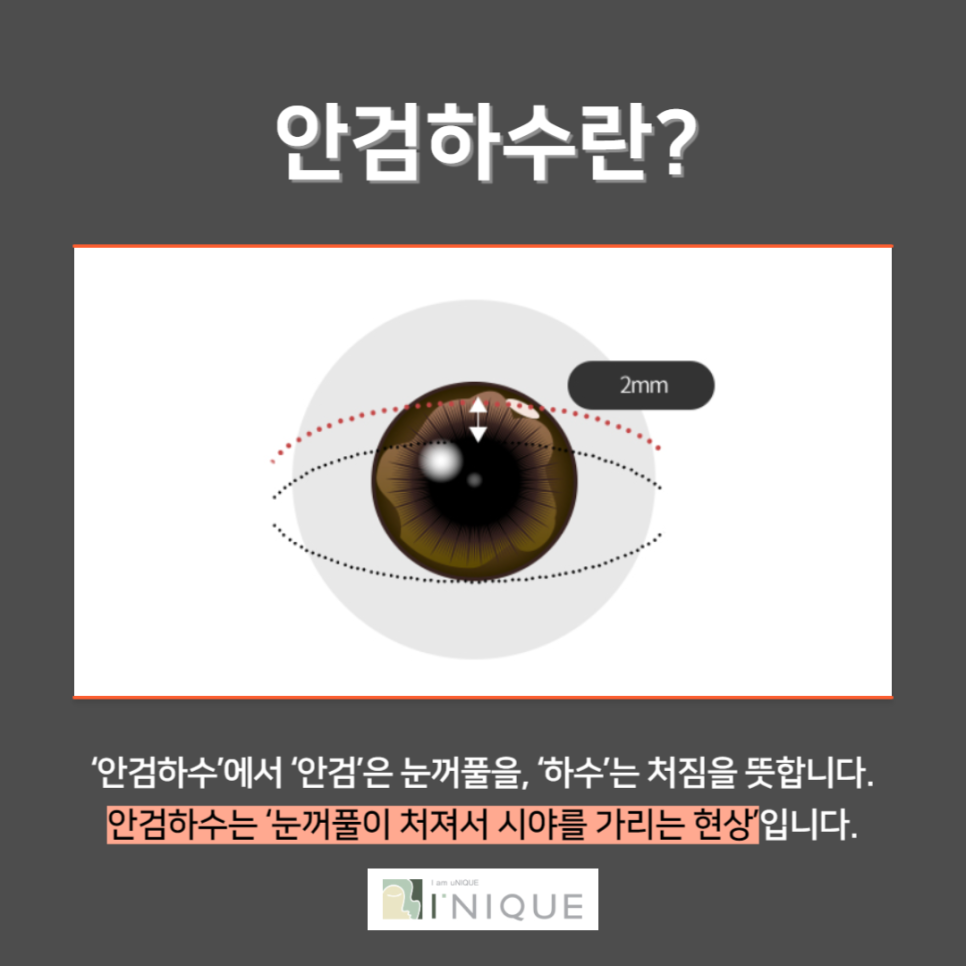 눈처짐해결에 가장 효과적인 방법! 관련 이미지 3
