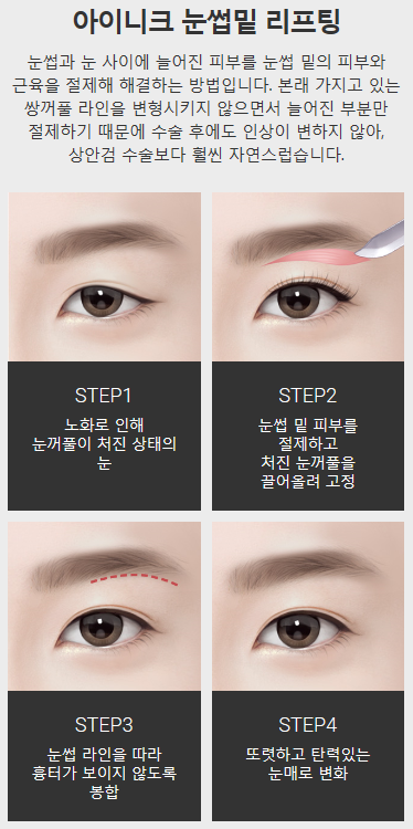 눈썹거상술 필요하신가요? 관련 이미지 4