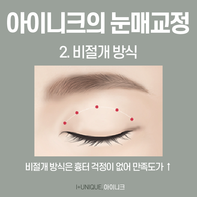 흐릿한 눈매가 고민인 여자분들, 비절개 눈매교정술 상담 받으세요! 관련 이미지 4