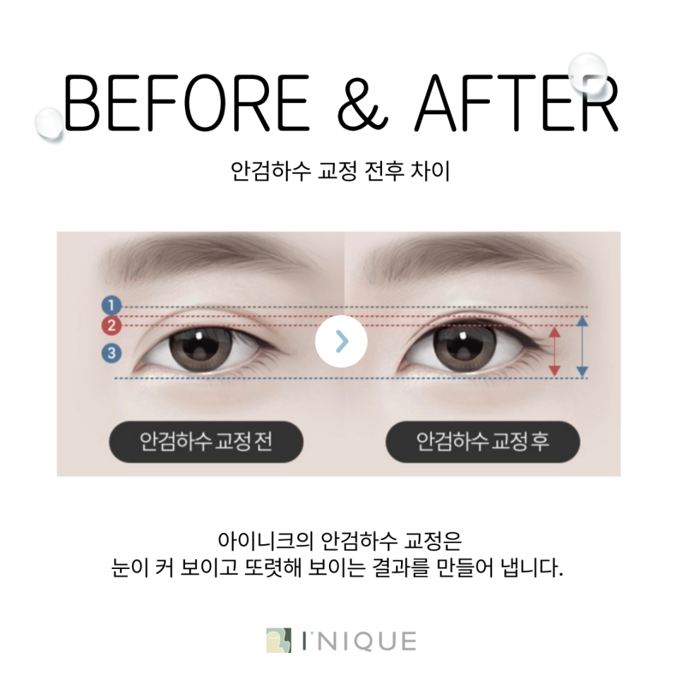 소세지쌍꺼풀재수술, 고민되시나요? 관련 이미지 5
