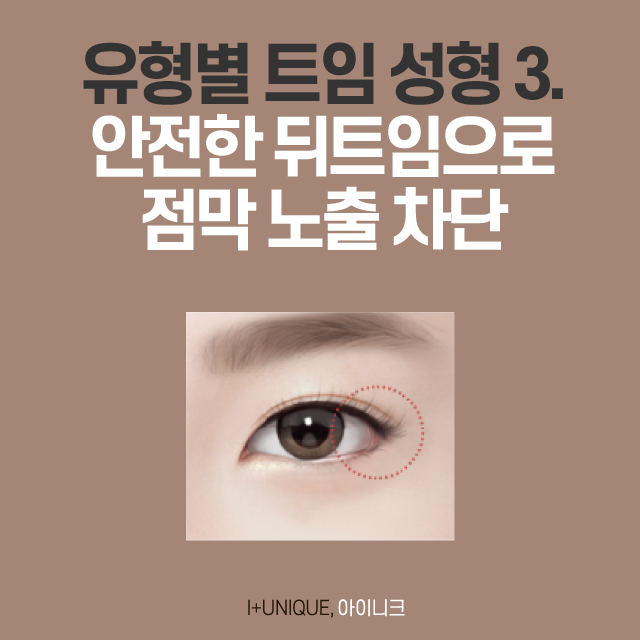 트임 성형의 종류, 그리고 트임 후기! 관련 이미지 4