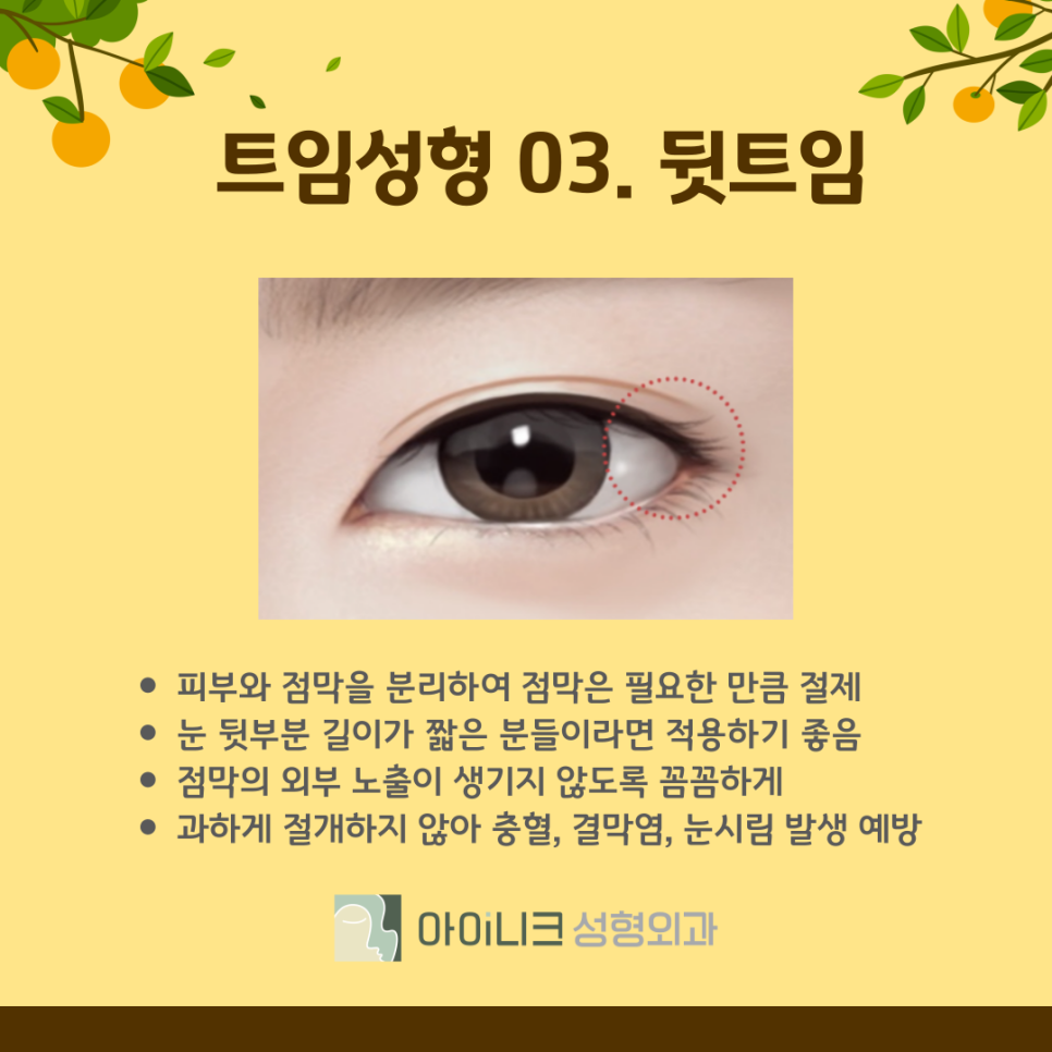 눈트임 수술 종류 나에게 맞는 방법은? 관련 이미지 9