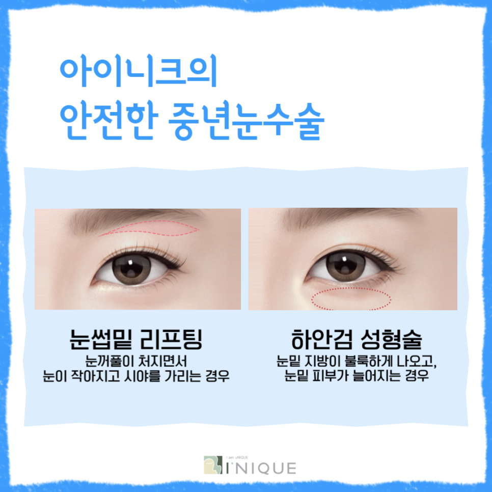 For a Brighter, More Youthful Impression with Midlife Eye Surgery image 2