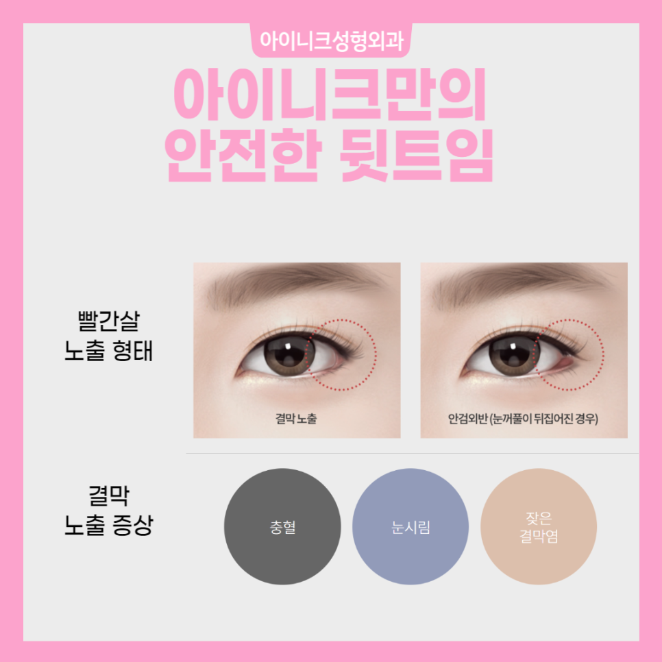 앞트임뒤트임 아름다운 눈을 위한 선택 관련 이미지 4