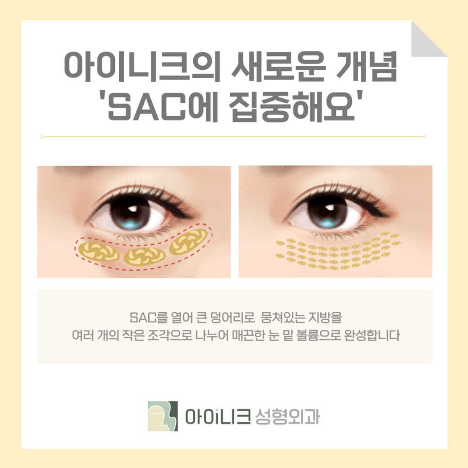눈밑지방재배치통증 걱정되시나요? 관련 이미지 6