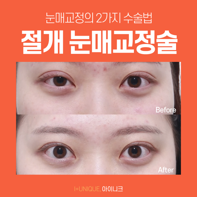 비절개눈매교정술로 자연스럽고 예쁜 눈매 만들기? 관련 이미지 3