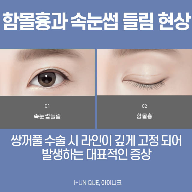 쌍꺼풀수술흉터 없이 성공하는 방법 관련 이미지 2