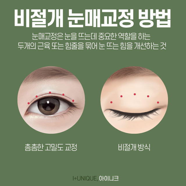 졸린눈이 고민이라면 눈매교정안검하수로 또렷하게 되돌리자 관련 이미지 4