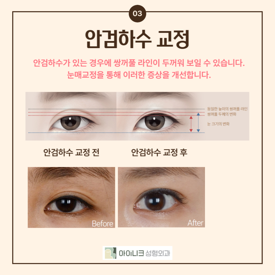 If You’re Looking for a Place That Specializes in Revision Eyelid Surgery, Take Note! image 4