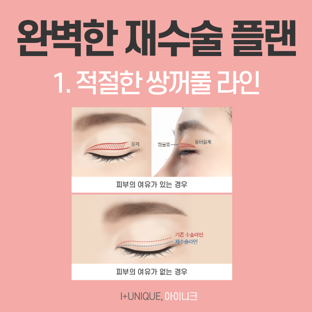 믿을 수 있는 쌍꺼풀라인재수술 병원은? 관련 이미지 4