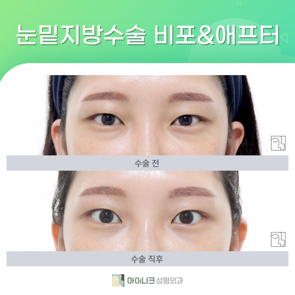 눈밑수술센터에서 더 환하고 밝은 눈 밑 만들기! 관련 이미지 6