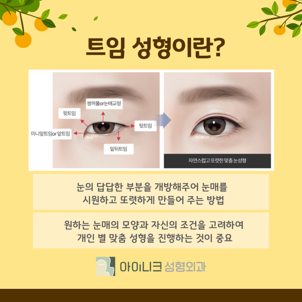 눈트임 수술 종류 나에게 맞는 방법은? 관련 이미지 4