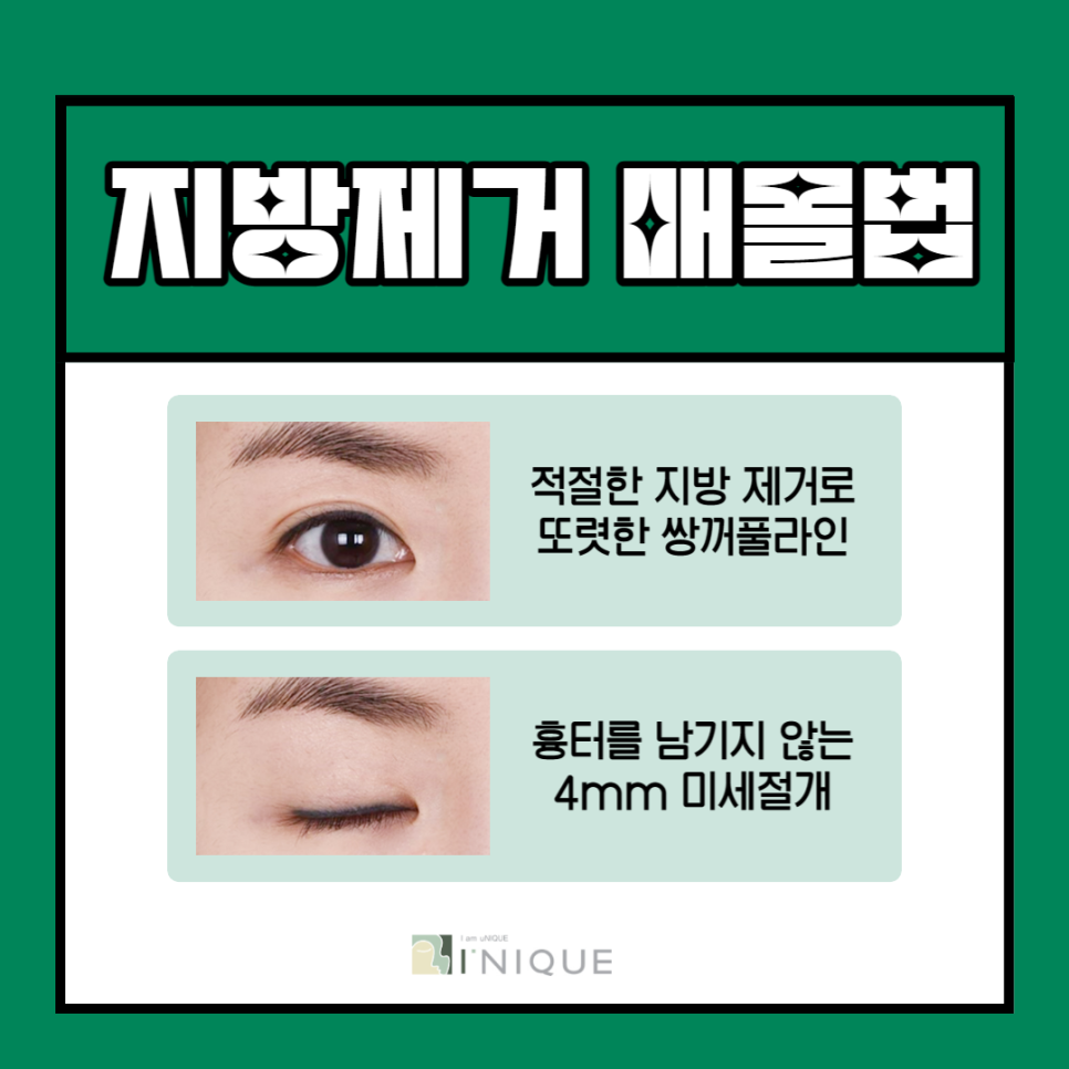직장인 쌍수, 붓기 회복 시간을 단축하려면? 관련 이미지 4