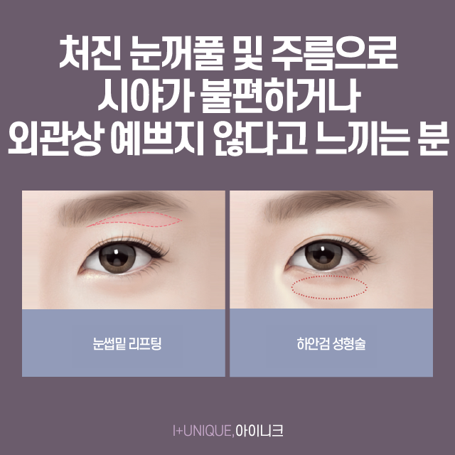 압구정 상안검수술 눈꺼풀이 늘어진 분이라면 주목 관련 이미지 2