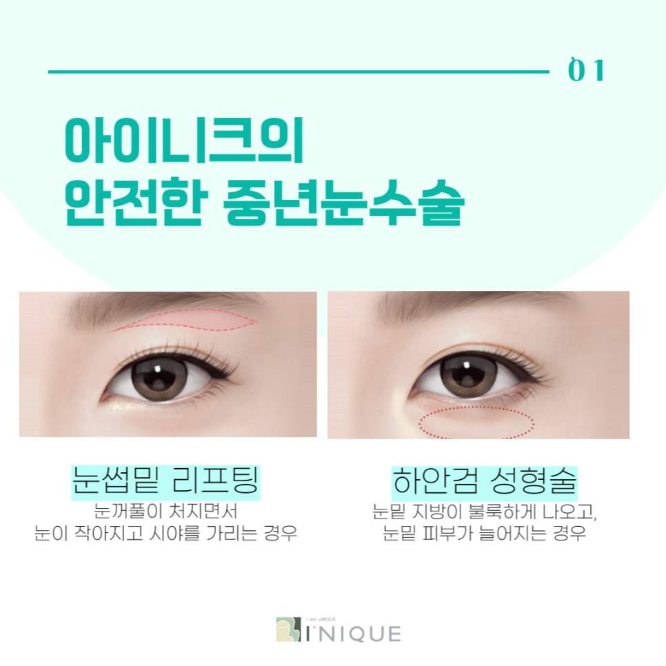 중년눈수술로 다시 20대의 눈매로 관련 이미지 2