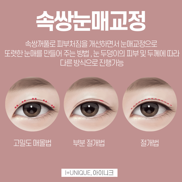 남자눈성형추천을 받고 싶다면 어떻게 해야할까 관련 이미지 3