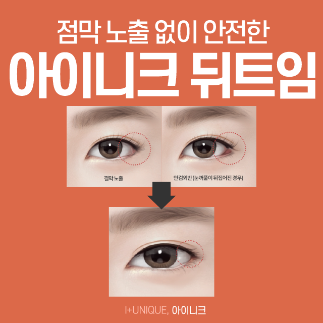 안전한 앞, 뒤트임복원 수술로 새롭게 태어나세요! 관련 이미지 5
