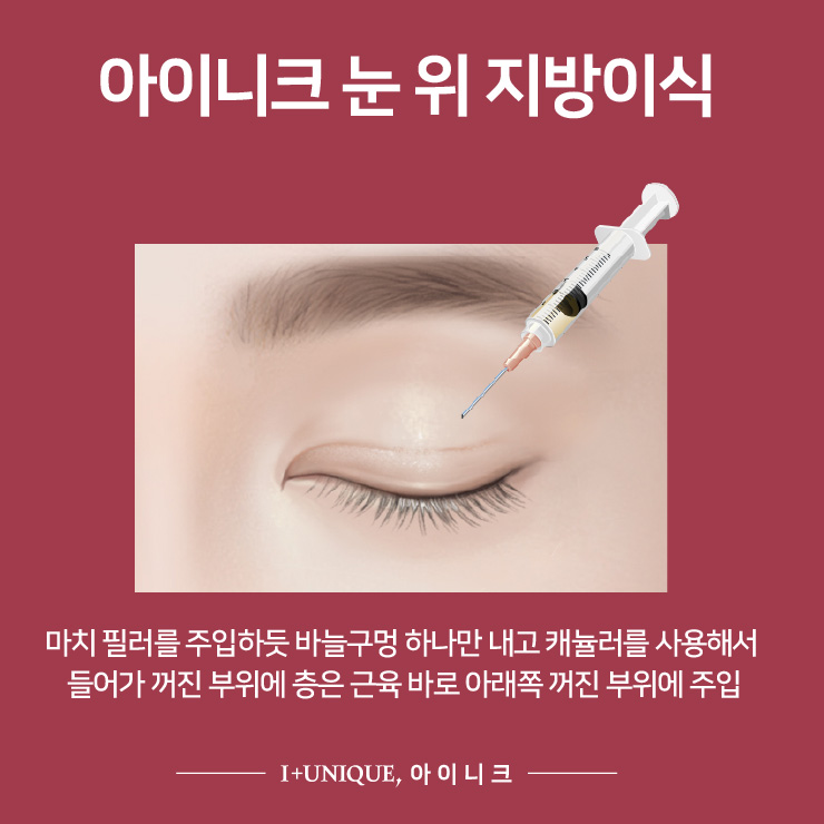 쌍꺼풀이 여러겹? 삼꺼풀 탈출하기 #2 관련 이미지 4