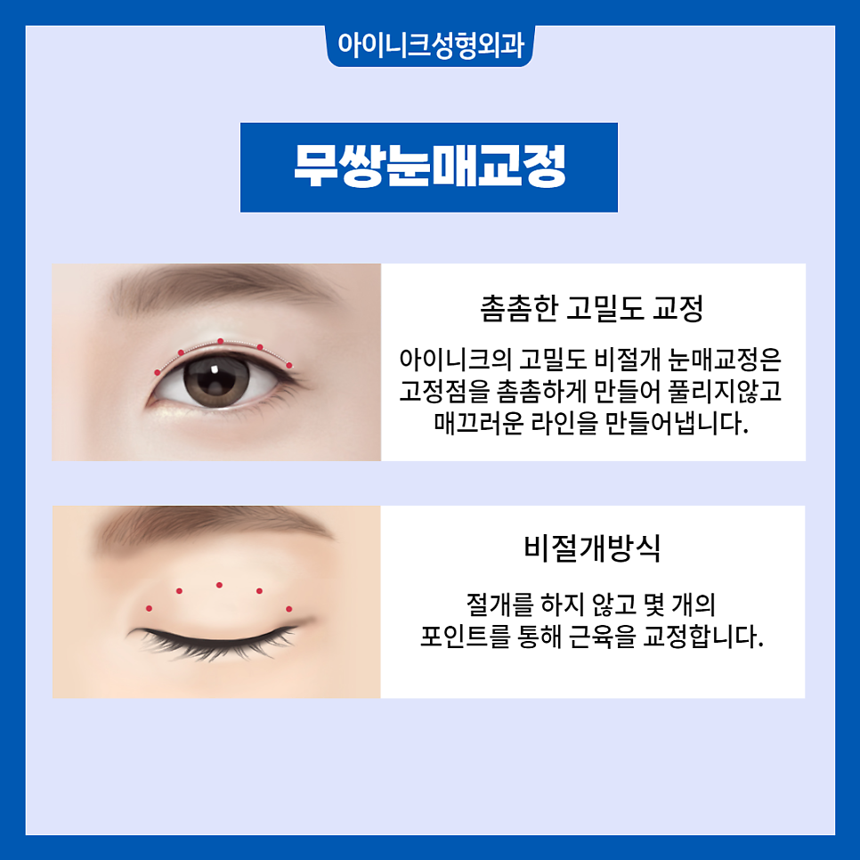 남자쌍꺼풀수술 부드럽고 자연스럽게 관련 이미지 4