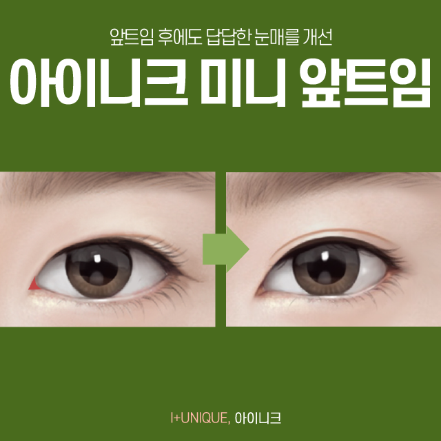 앞트임 후에도 계속 답답해 보인다면 아이니크에서 복원술을 받아보세요!! 관련 이미지 4