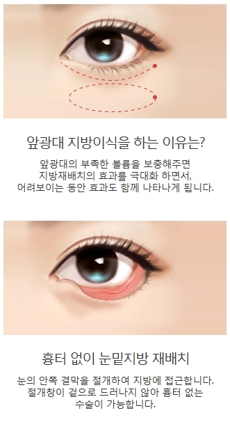 다크서클수술비용 환해진 눈밑을 느껴보세요 관련 이미지 5