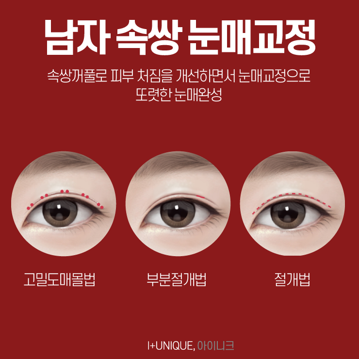남자눈매교정병원 아이니크성형외과에서 알려주는 자연스러운 눈성형방법 관련 이미지 3
