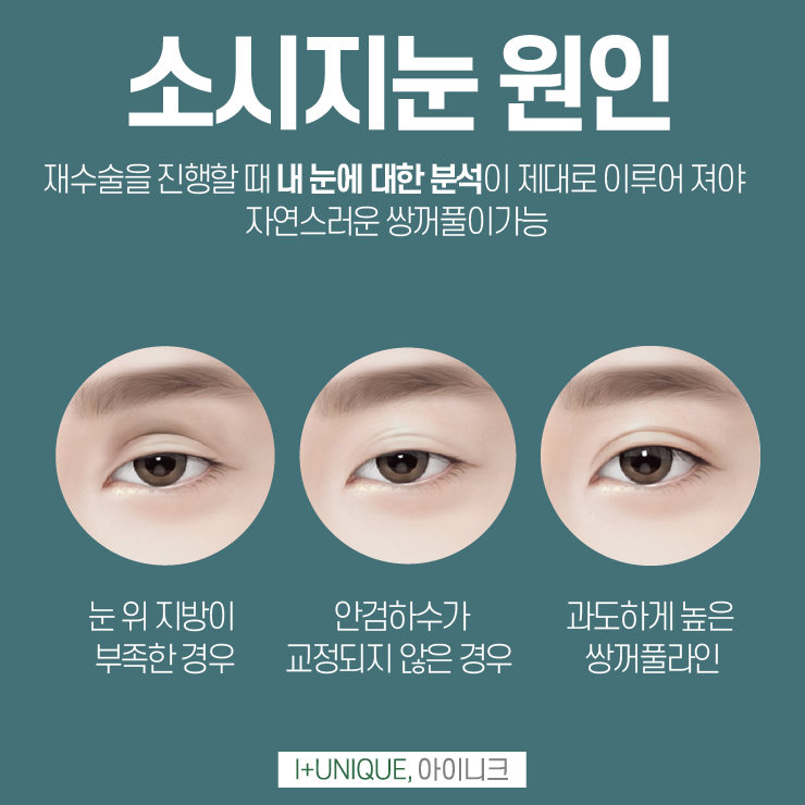 아이니크성형외과에서 두줄따기로 소시지눈 탈출 관련 이미지 3