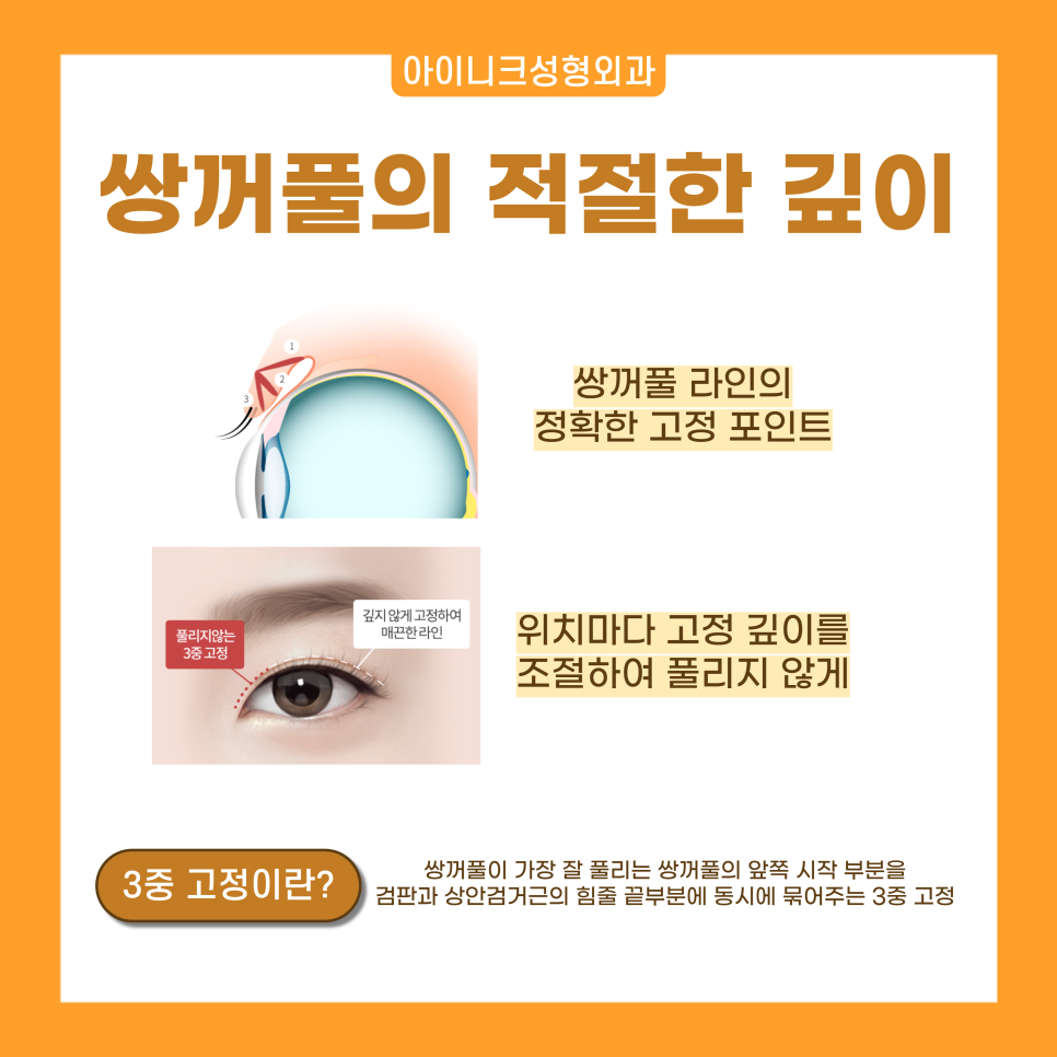 쌍수성형외과 자연스러움을 원한다면 눈성형전문 아이니크로 관련 이미지 4