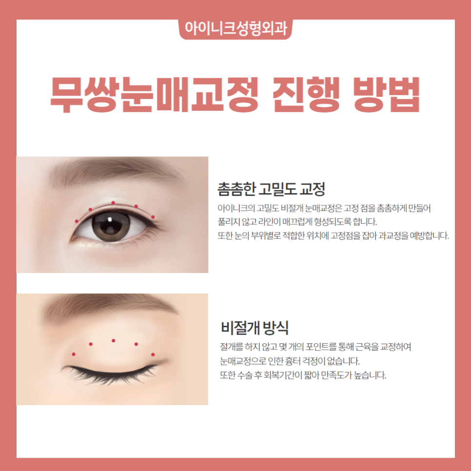자연스러운 남자무쌍눈매를 원한다면 관련 이미지 5