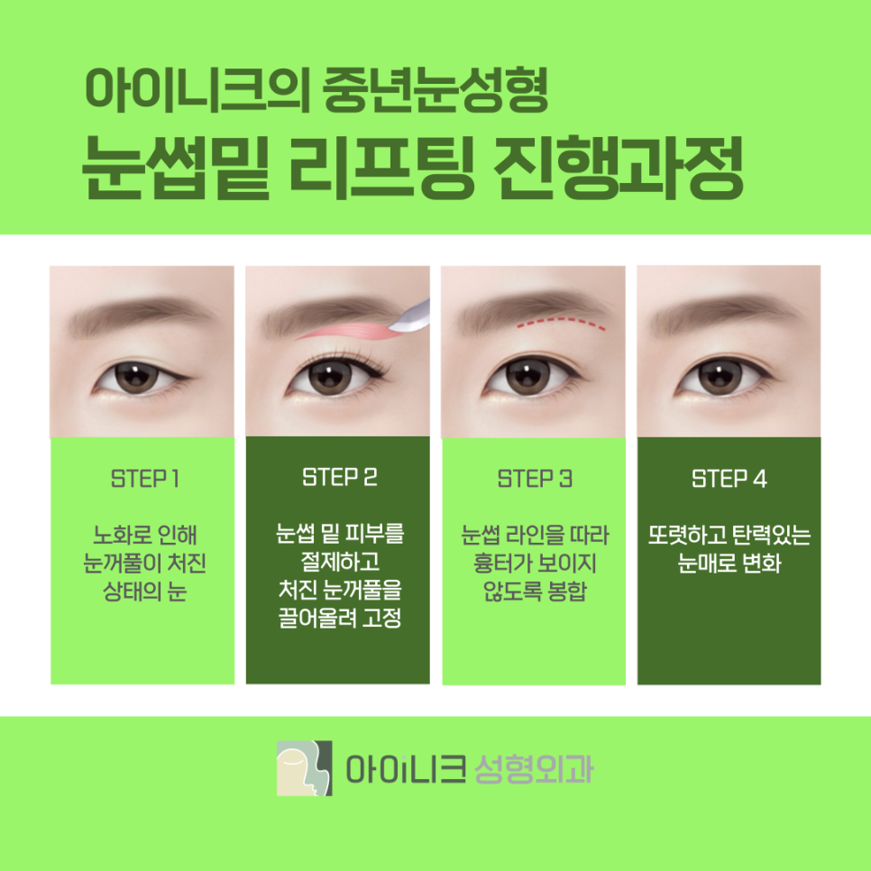 쌍수병원 잘하는곳에서 20대의 눈매로 돌아가기 관련 이미지 8
