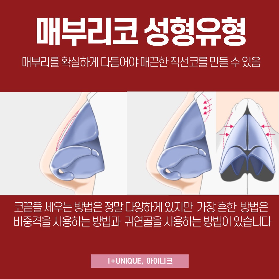 남자코성형은 어떻게 다를까 아이니크성형외과에서 알아보기 관련 이미지 4