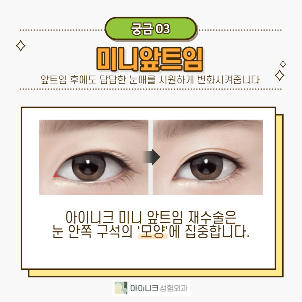 Let’s Take a Proper Look at Revision Eye Surgery! image 4