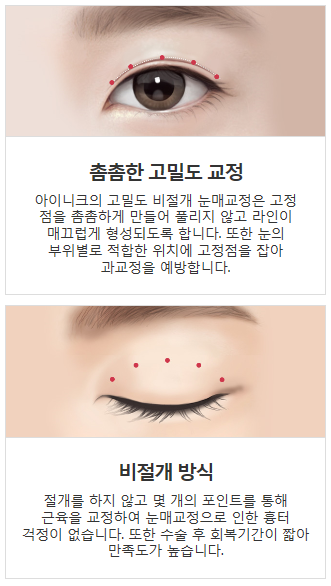 눈매교정술가격 좁은 시야를 개선하자! 관련 이미지 4