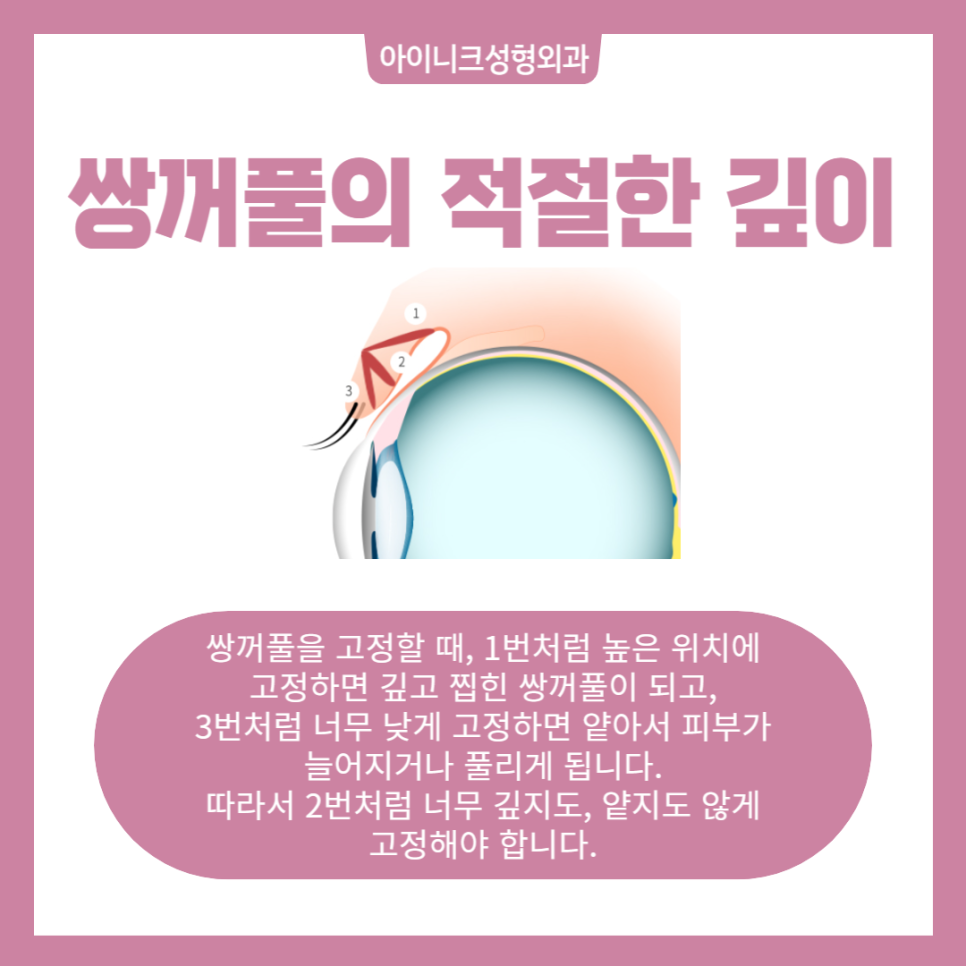 작은눈수술, 자연스러운 쌍꺼풀라인으로 관련 이미지 3