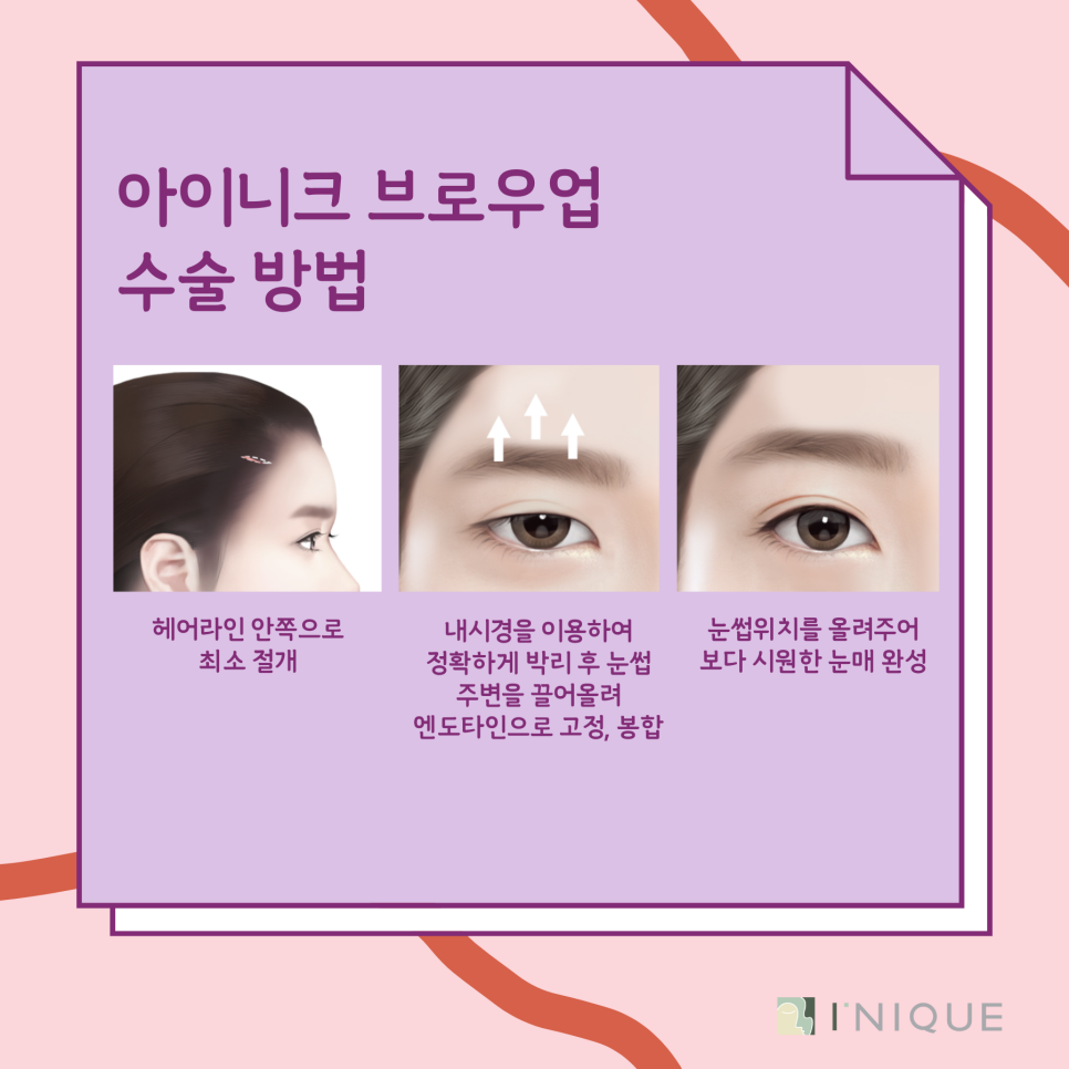 If You’re Curious About How an Eyebrow Lift Works image 4