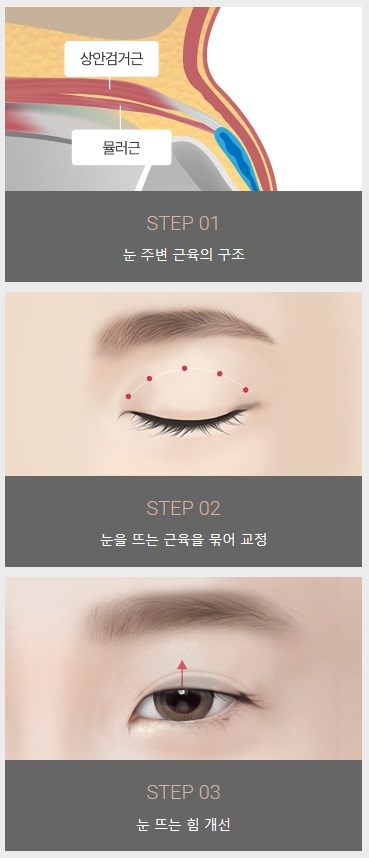 비절개눈매교정술 간단하지만 확실한 관련 이미지 4