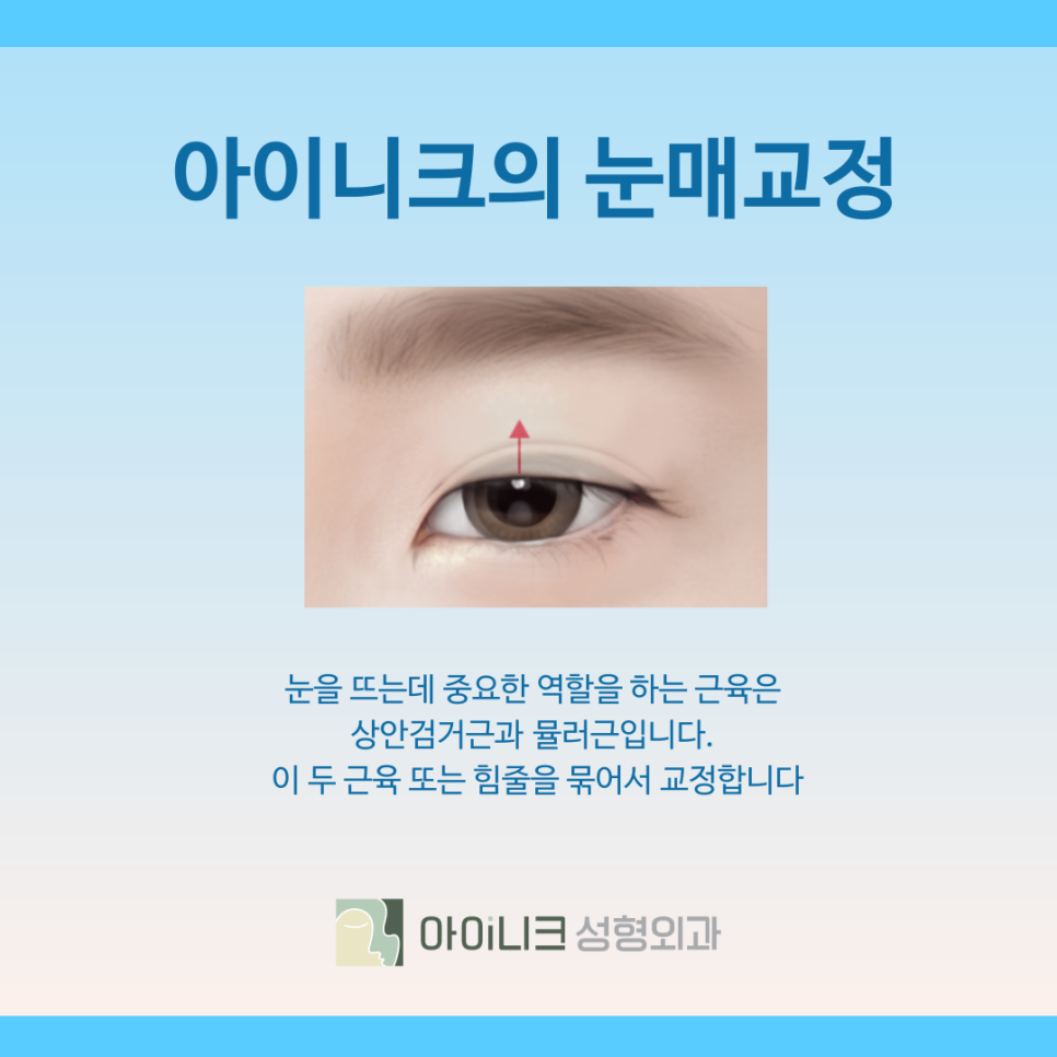 How to Improve Droopy Eyes with Ptosis Surgery in Seoul image 6