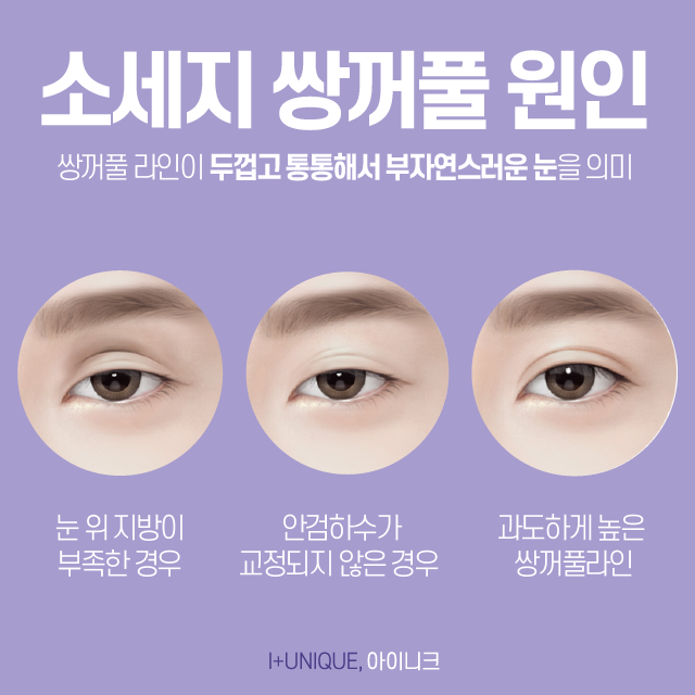 압구정쌍꺼풀재수술, 어떻게 하면 다시 자연스럽게 되돌릴 수 있을까 관련 이미지 2