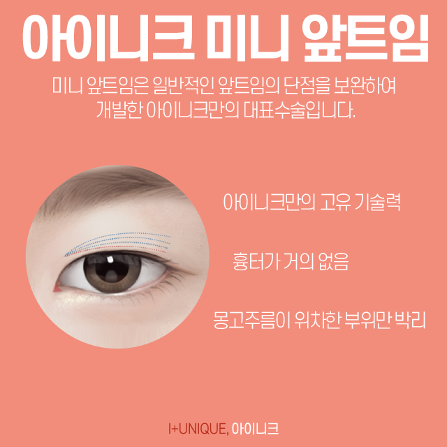 답답해 보이는 몽고주름앞트임, 시원하게 만들고 싶다면? 관련 이미지 3