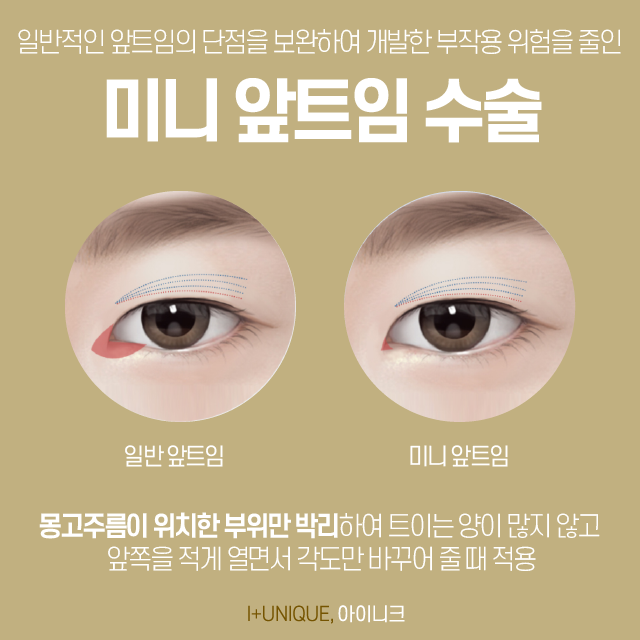 눈성형외과유명한곳 그 중, 자연스러운 트임을 원한다면? 관련 이미지 3
