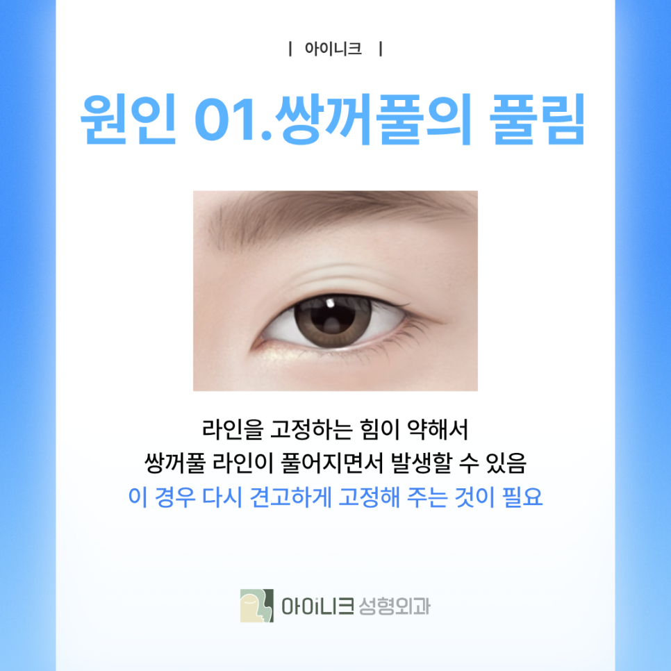 쌍꺼풀재수술병원 겹주름이 되어버렸다면? 관련 이미지 5
