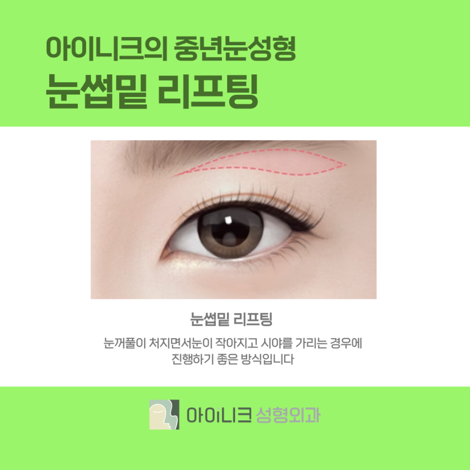 쌍수병원 잘하는곳에서 20대의 눈매로 돌아가기 관련 이미지 6