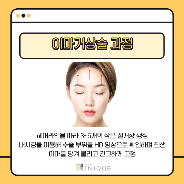 중년안면거상, 안전하게 하려면 관련 이미지 4