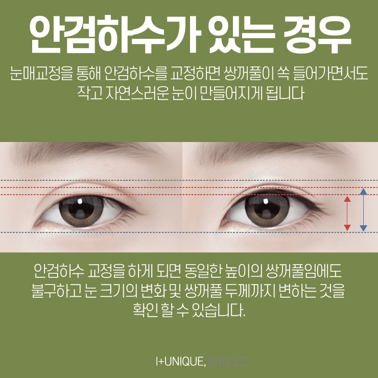 첫 수술만큼 중요한 눈재수술잘하는병원 고르기, 더이상 고민말고 아이니크로 관련 이미지 4