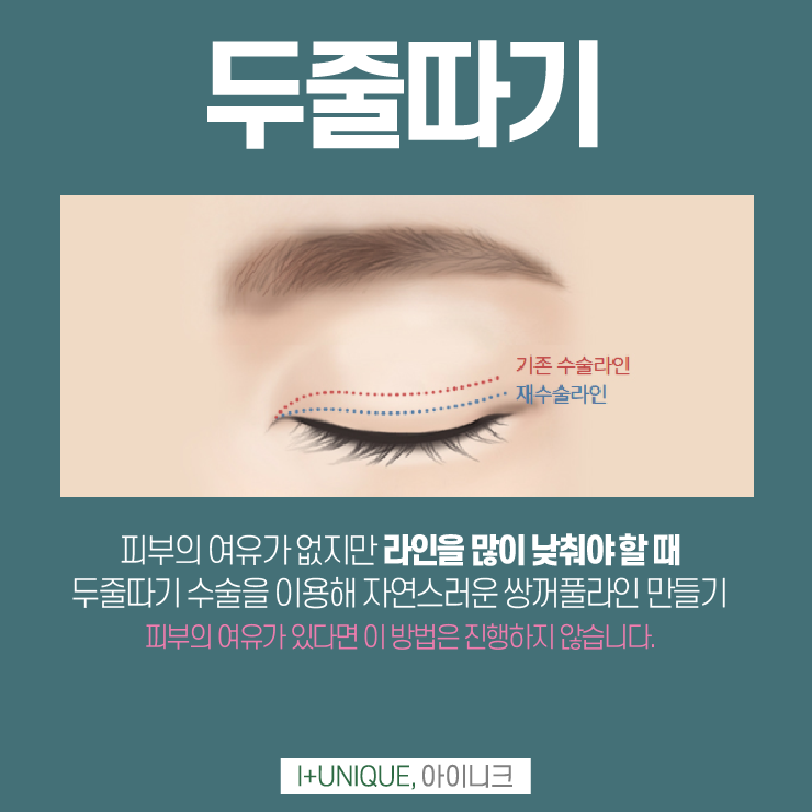 아이니크성형외과에서 두줄따기로 소시지눈 탈출 관련 이미지 4