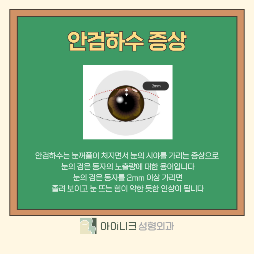 눈매교정수술로 눈 뜨는 힘 키워주기 관련 이미지 7