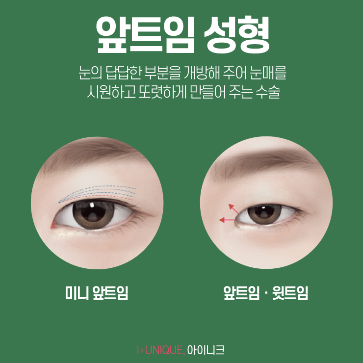 앞트임잘하는곳 찾아야 하는 이유! 아이니크성형외과에서 알려드립니다. 관련 이미지 2